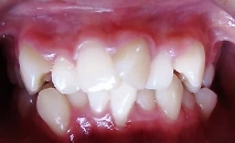小孩牙齿矫正什么时候开始会比较好些？