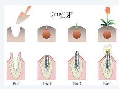 种植牙过程